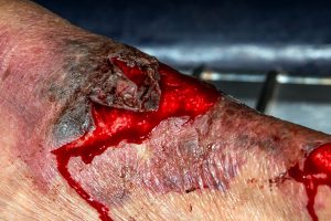 laceration