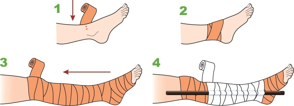 bandage snake bite