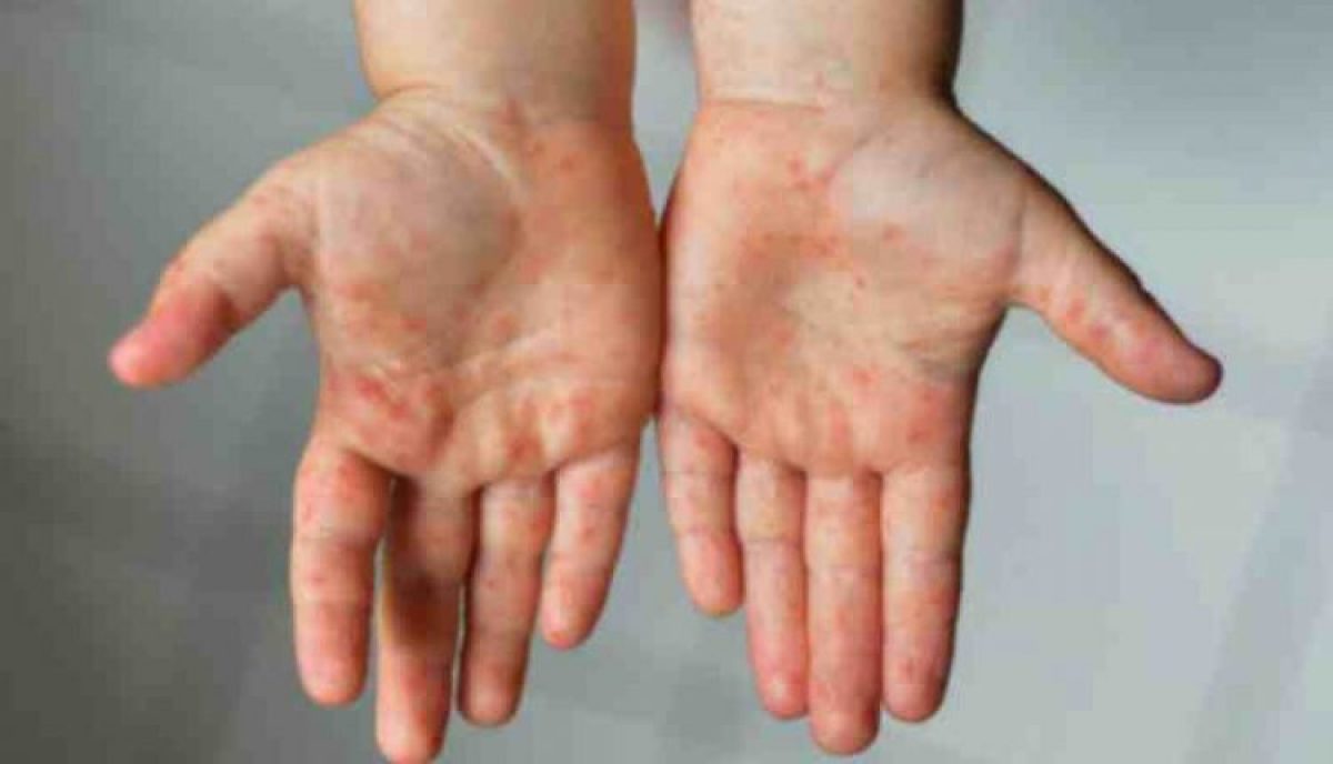 Kawasaki syndrome and disease in children, is a link?
