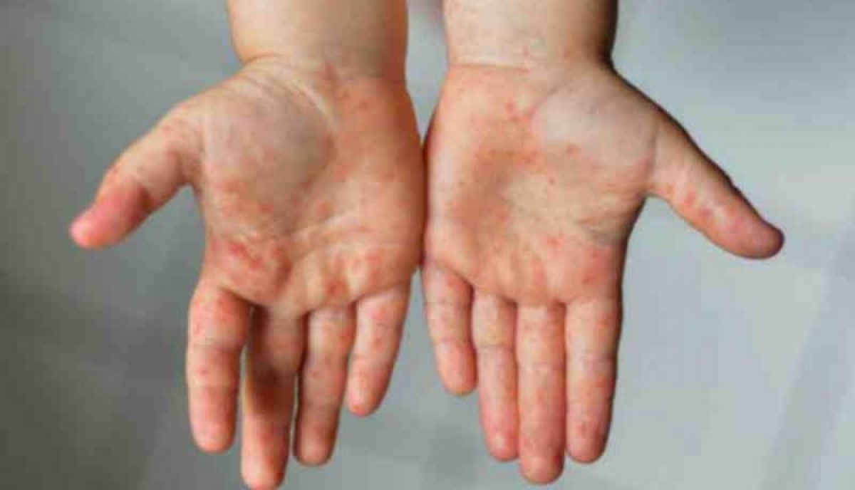 Kawasaki Syndrom Und Covid 19 Krankheit Bei Kindern Gibt Es Einen Zusammenhang