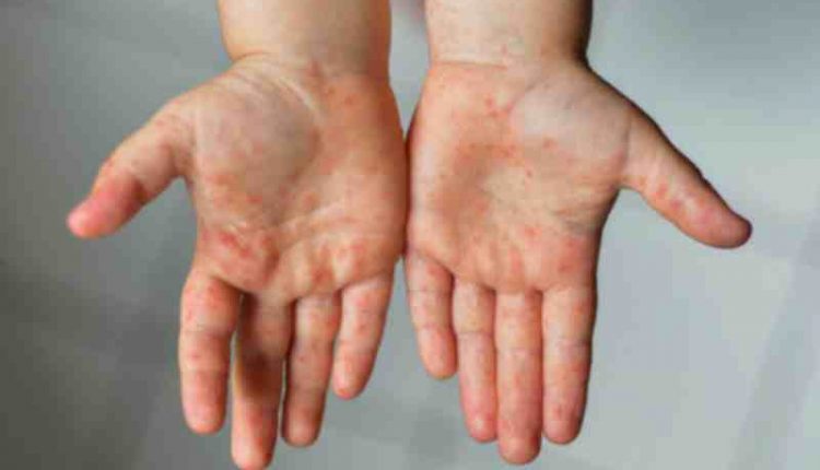 Emergency Live | Kawasaki syndrome and COVID-19 disease in children, is there a link? The most important and reliable studies