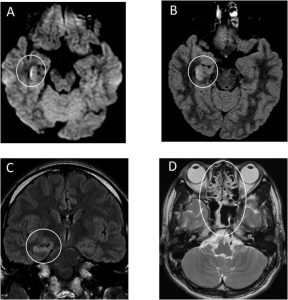 sars_cov_covid_brain_meningitis