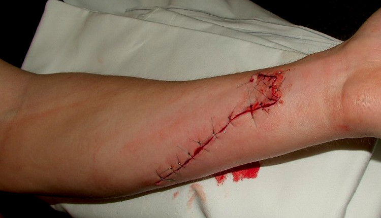Emergency Live | Case report: a jaw pain revealed to be a tetanus infection caused by a forearm wound