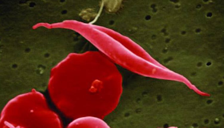 Emergency Live | Sickle Cell disease in Uganda: the Ministry of Health launched a campaign for awareness and healthcare improvement