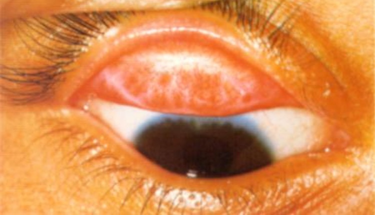 Trachome: symptômes, causes et traitement