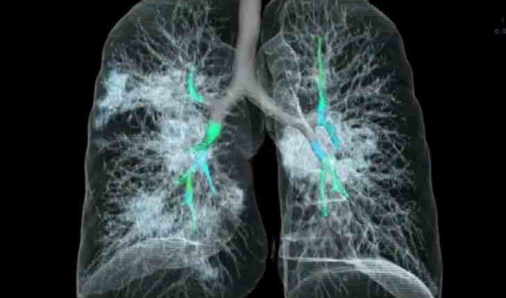 Emergency Live | Cuba, study on the effects of COVID-19 in the lungs: use stem cells