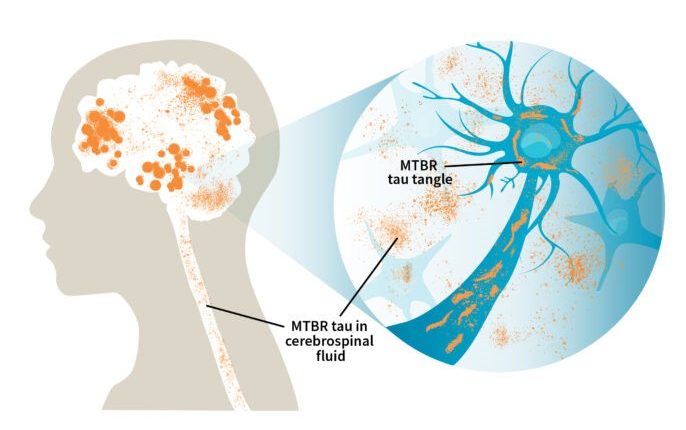 Emergency Live | Diagnosis of Alzheimer's disease, the study of researchers at Washington University on MTBR tau protein in cerebrospinal fluid