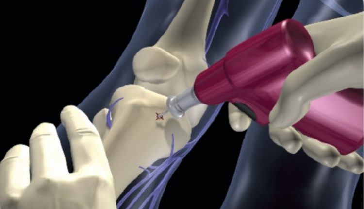 Intraosseous access, a life-saving technique in emergency shock management