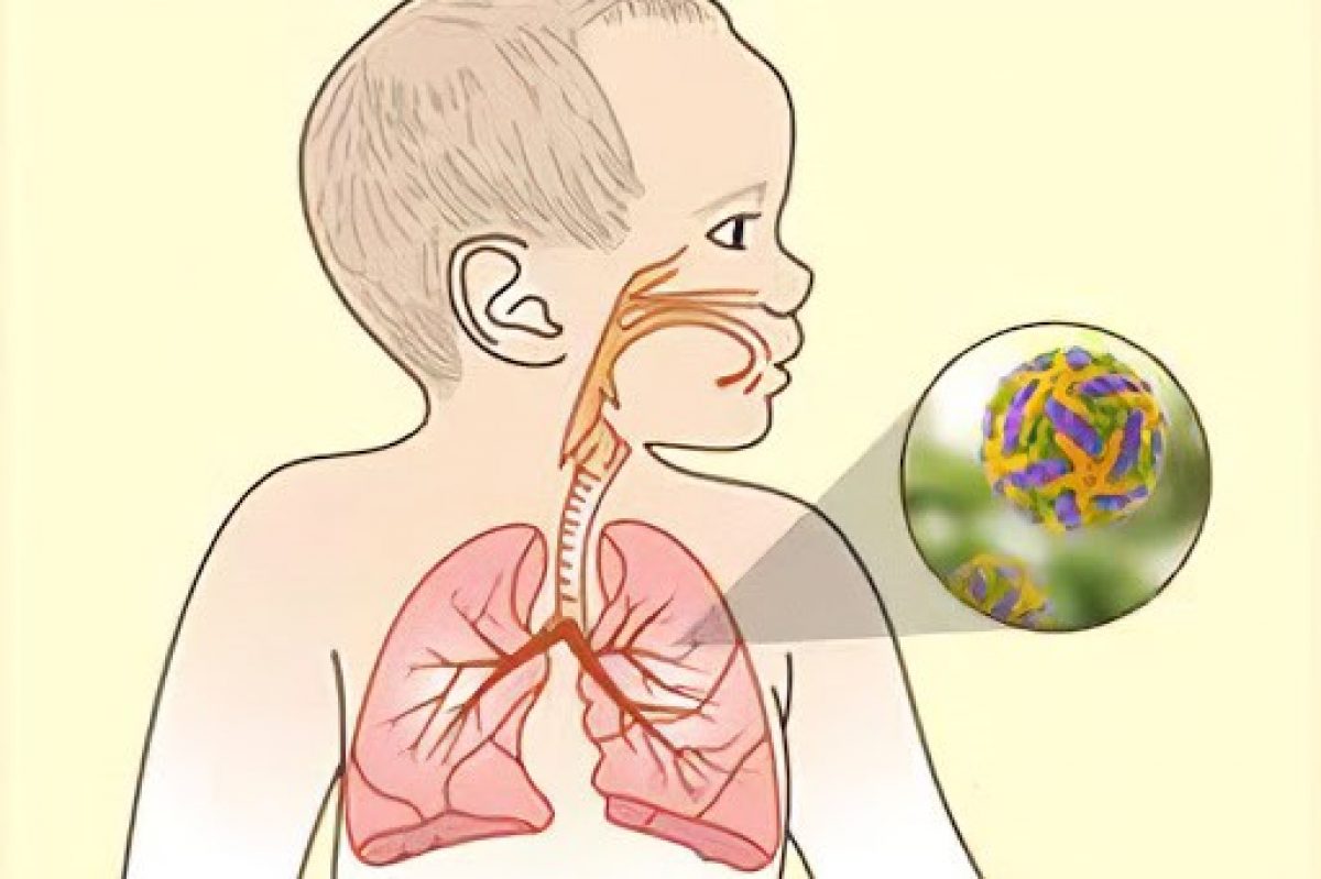 Italy / VRS Virus a leading cause of hospitalisation in the first year of  life