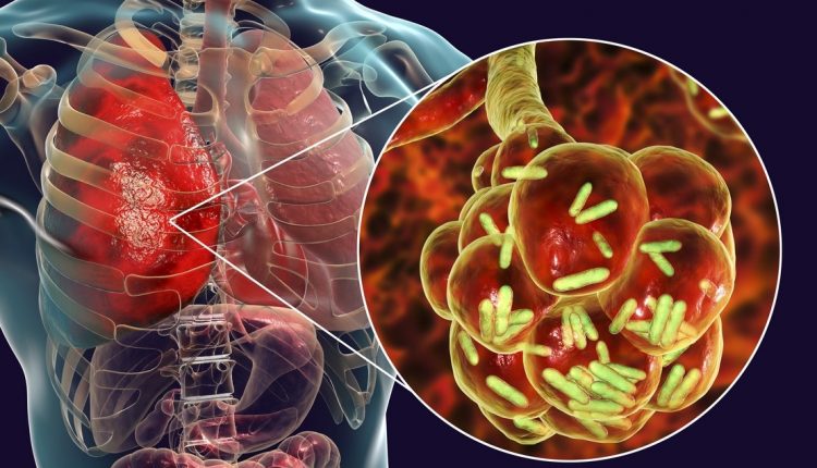 Who gets tuberculosis? Harvard Medical School study on immune cell deficiency