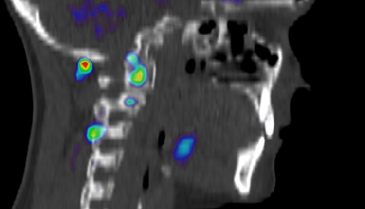 Visualizing Pain: injuries from whiplash made visible with new scanning approach