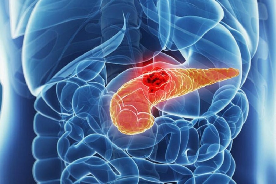 pancreatitis tünetek kezelés cukorbetegség új módszer a kezelés a cukorbetegség
