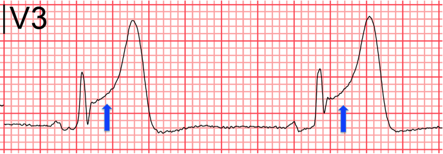 Infarto de miocardio con elevación del ST Qué es un STEMI Emergencia en vivo