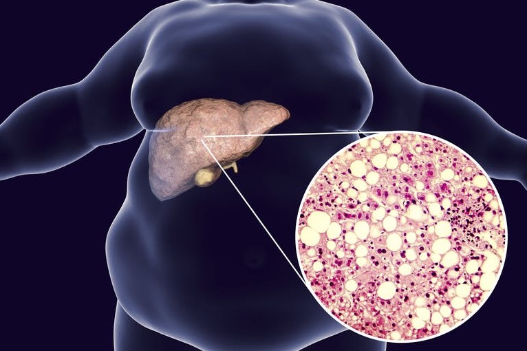 Hepatic steatosis: what it is and how to prevent it | Emergency Live