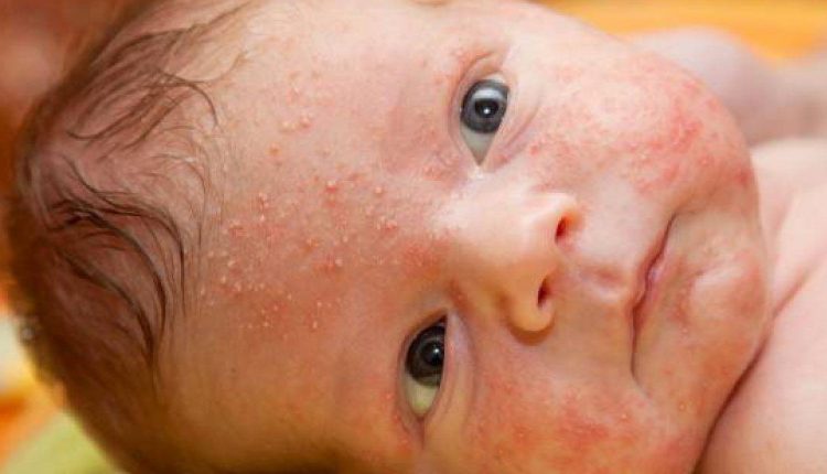 Impetigo