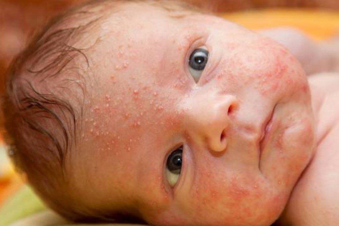 impetigo in children face