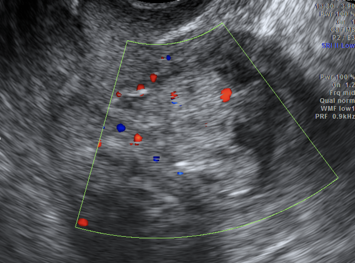 Transvaginal ultrasound