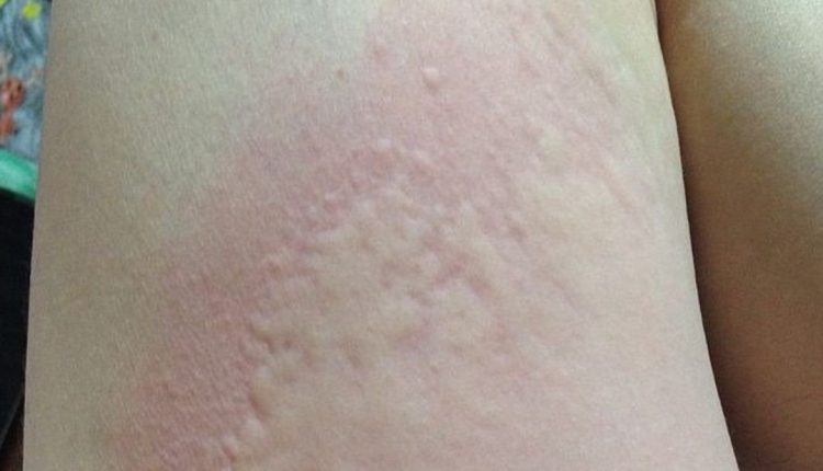 What is urticaria (hives)? The role of histamine and how to intervene