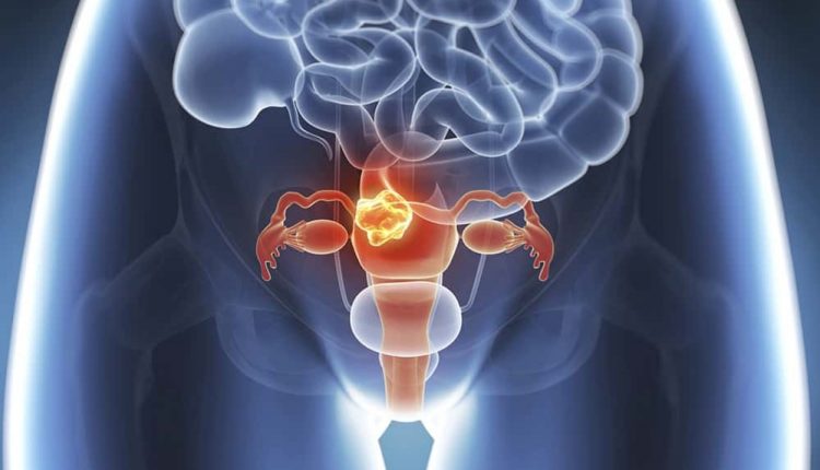 Myomas