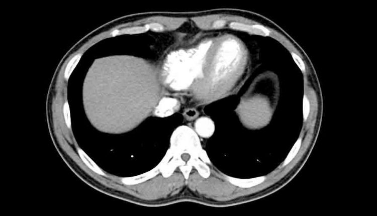 CT scan of the chest in smokers: what it is used for and why it is essential