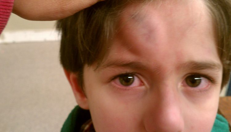 Head trauma in children: how the ordinary citizen should intervene while waiting for the rescuers