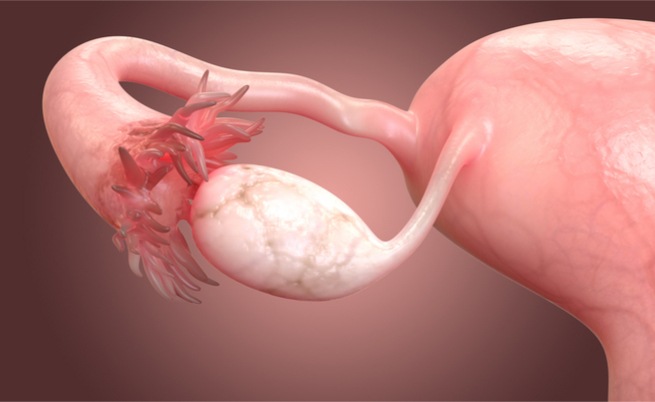 Polycystic ovary syndrome: signs, symptoms and treatment