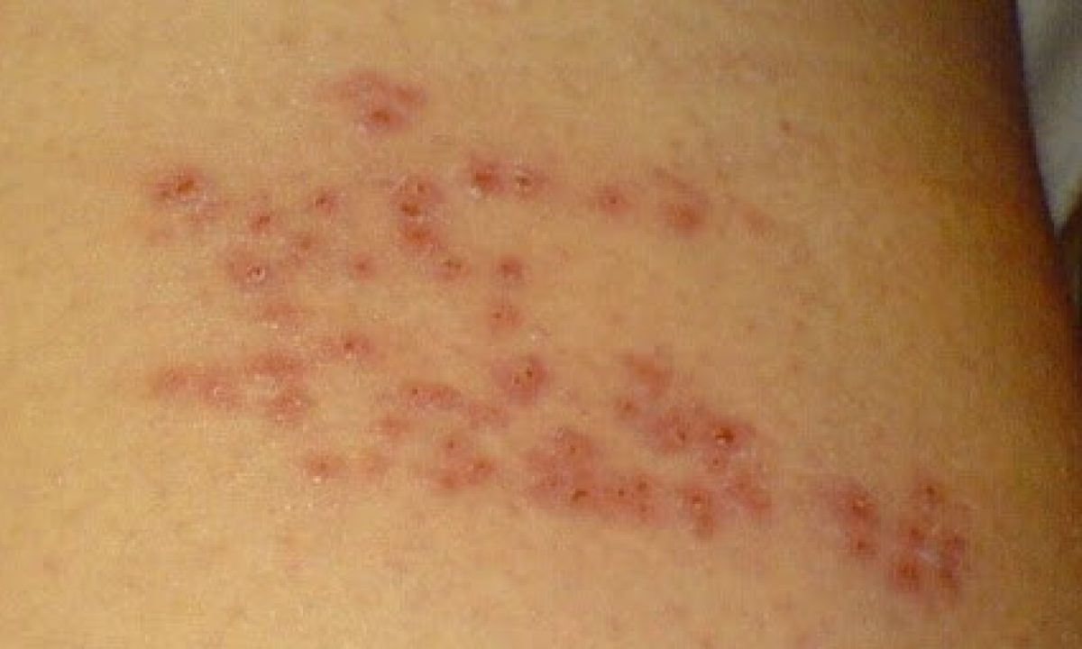 Herpes-Zoster-fuoco-sant-antonio-1-1200x720.jpg