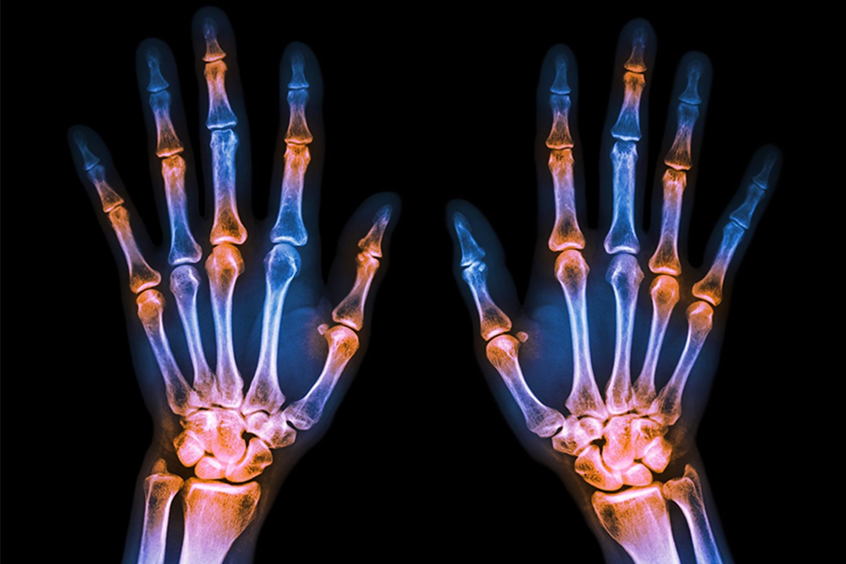 A láb rheumatoid arthritisének kezelése