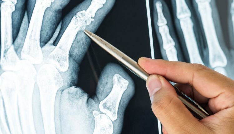X-ray wrist fracture