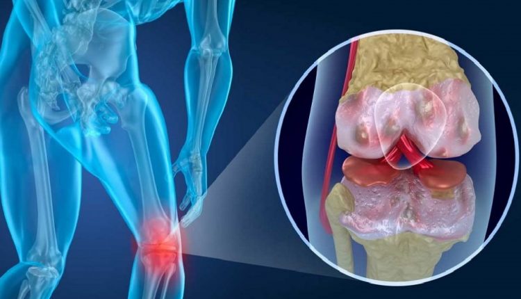 Joint pain: rheumatoid arthritis or arthrosis?