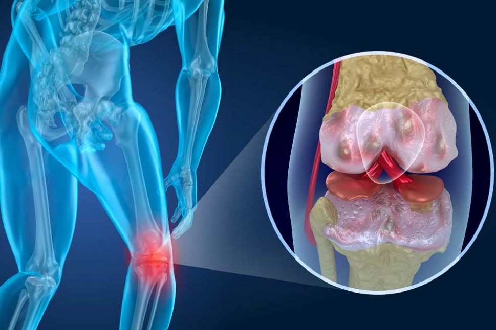 dureri articulare artrită artroză osteoartrita care implică articulațiile mari