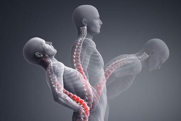 Ankylosing spondylitis: what is it and how is it diagnosed?