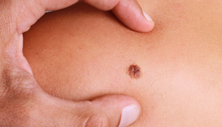 Moles