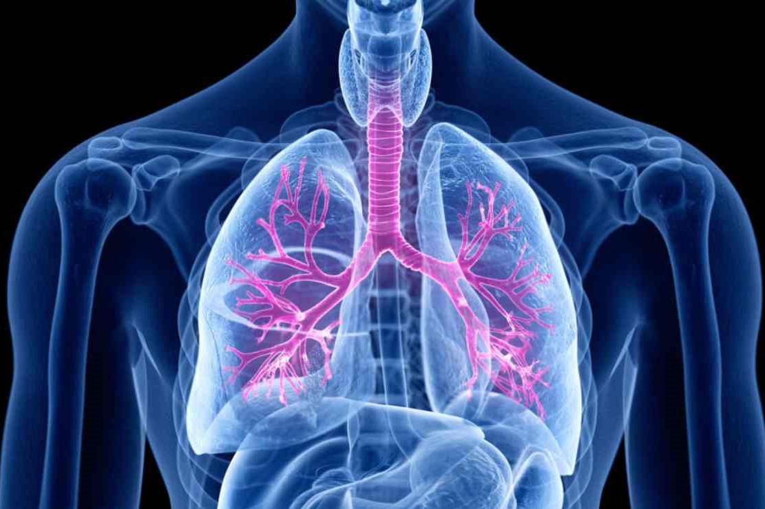 Bronchitis Bronchitis: When