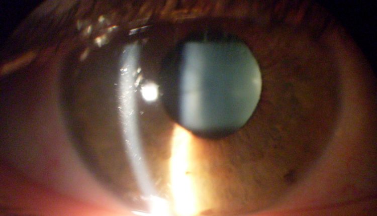 Dry eye