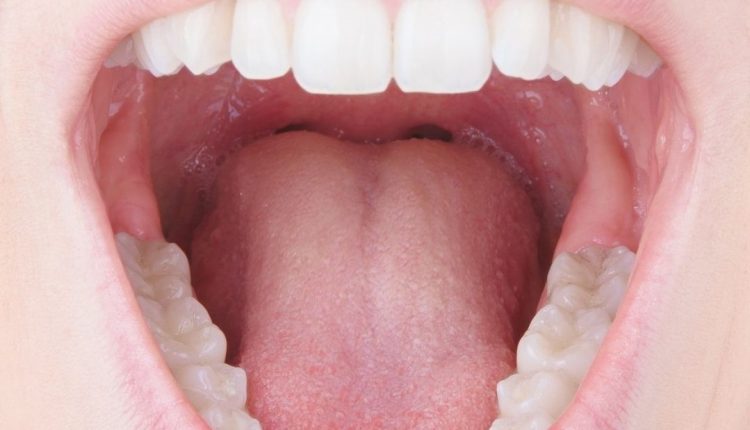 Tonsil