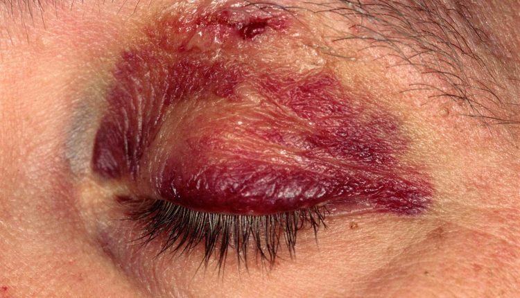 Contusions