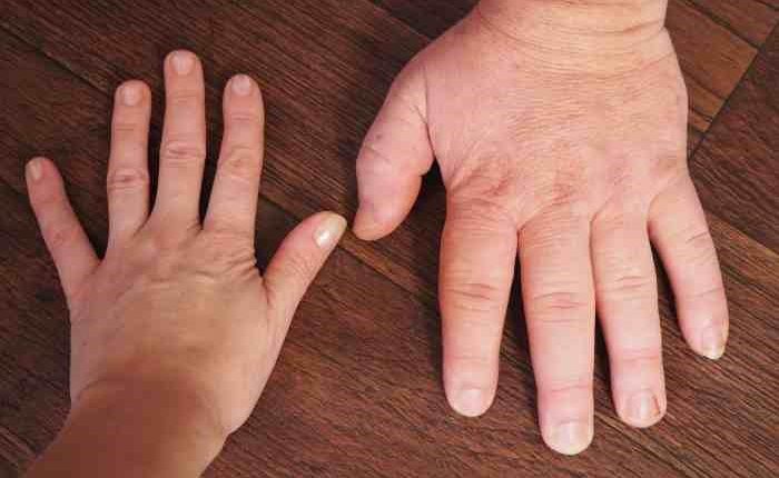 acrogigantism