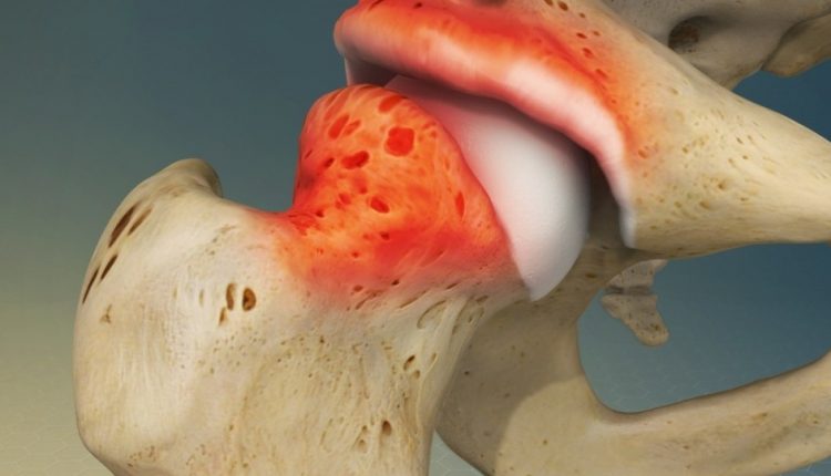 Femoroacetabular impingement (FAI): treatment and recovery