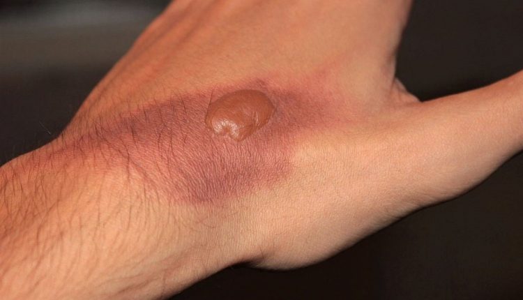 blister burn