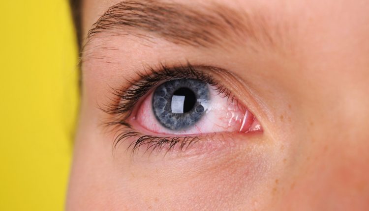 red eyes