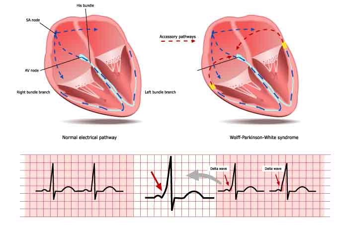 Wolff-Parkinson-White syndrome: pathophysiology, diagnosis, treatment