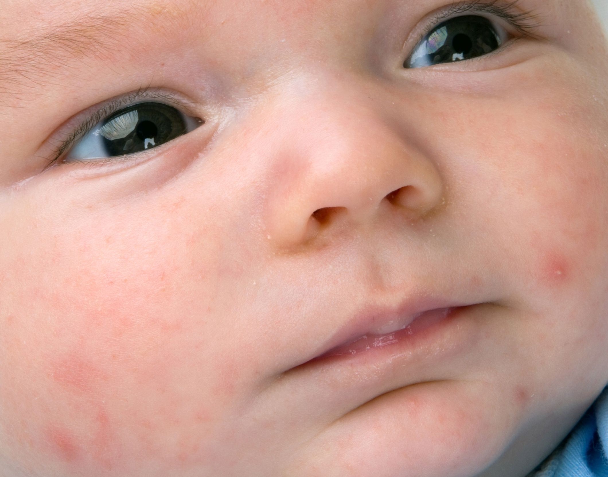 Есть ли аллергия на гречку. Акне новорожденных (неонатальный пустулез). Транзиторный неонатальный цефалический пустулез.