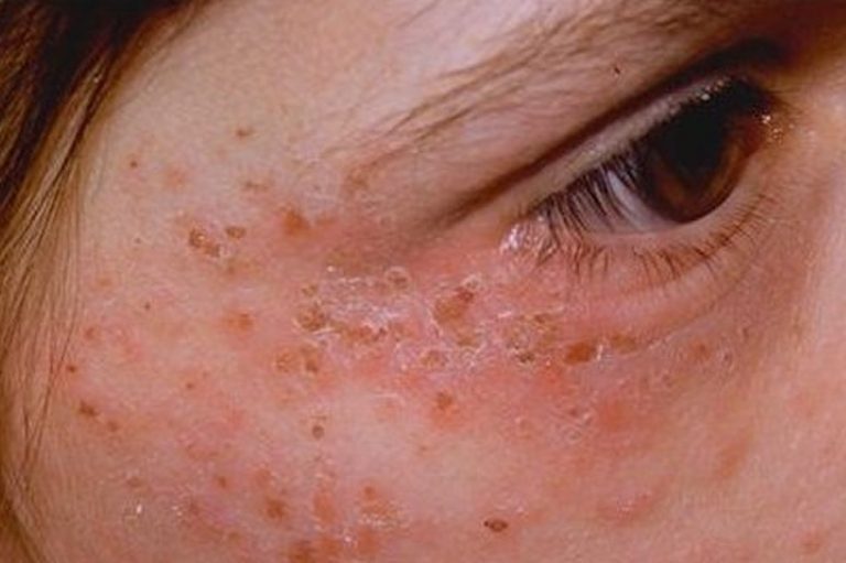 ポルフィリン症とは何ですか? この遺伝病の診断と治療