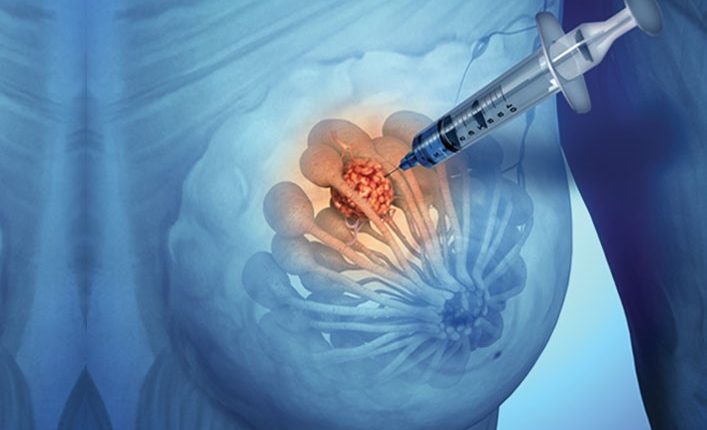 Biopsy: what it is and when it is performed | Emergency Live Biopsy: what it is and when it is performed | Emergency Live