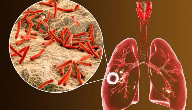 Tubercolosis TBC