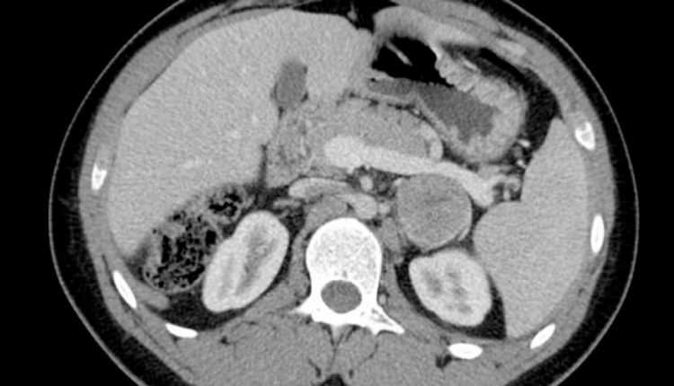adrenal gland