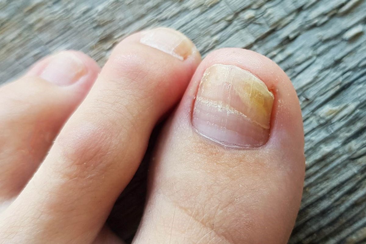 Onychomycosis: why do fingernails and toenails get fungus?