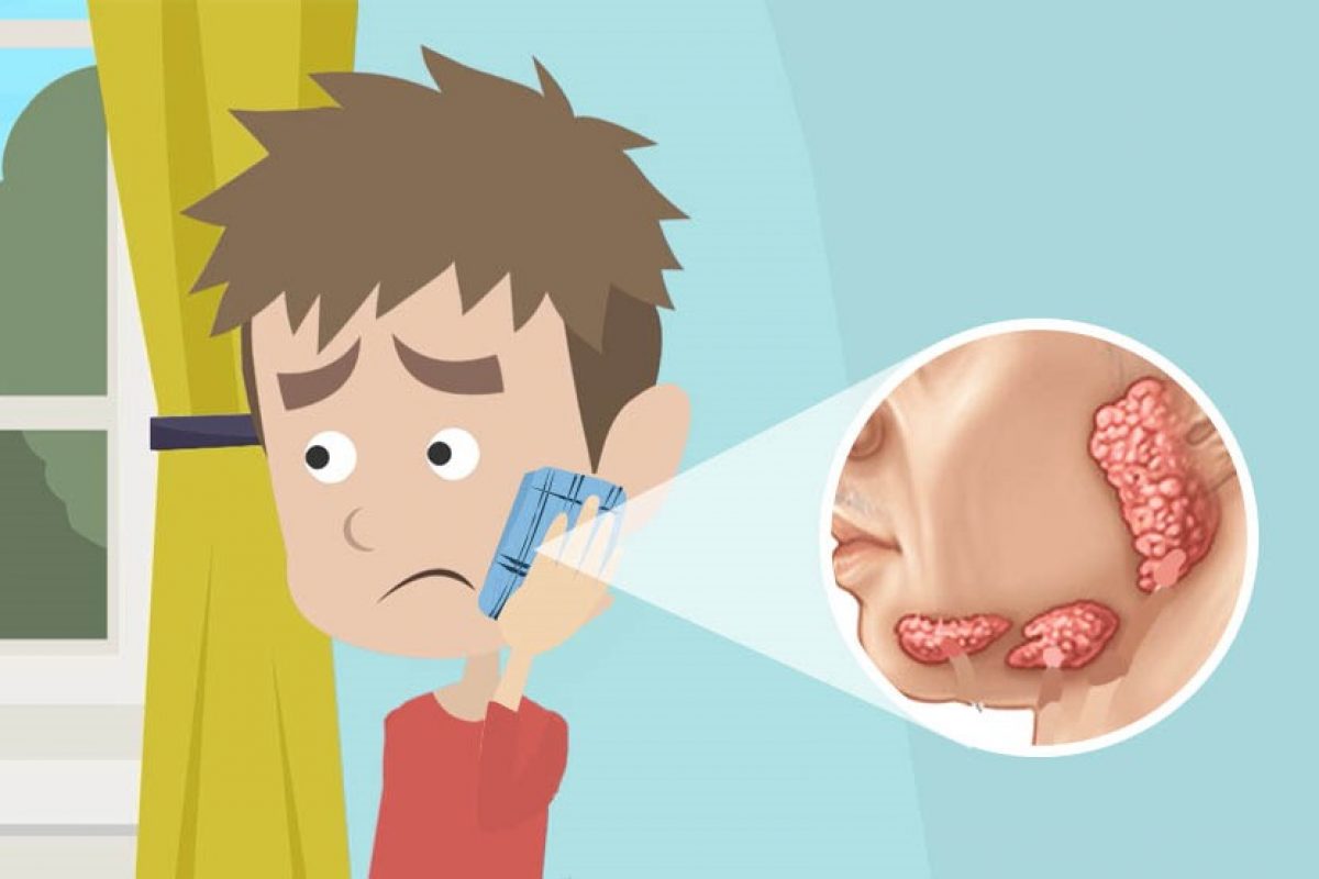 Simplemente desbordando familia contenido Parotiditis: síntomas, tratamiento y prevención de las paperas. Simplemente desbordando familia contenido Parotiditis: síntomas, tratamiento y prevención de las paperas.