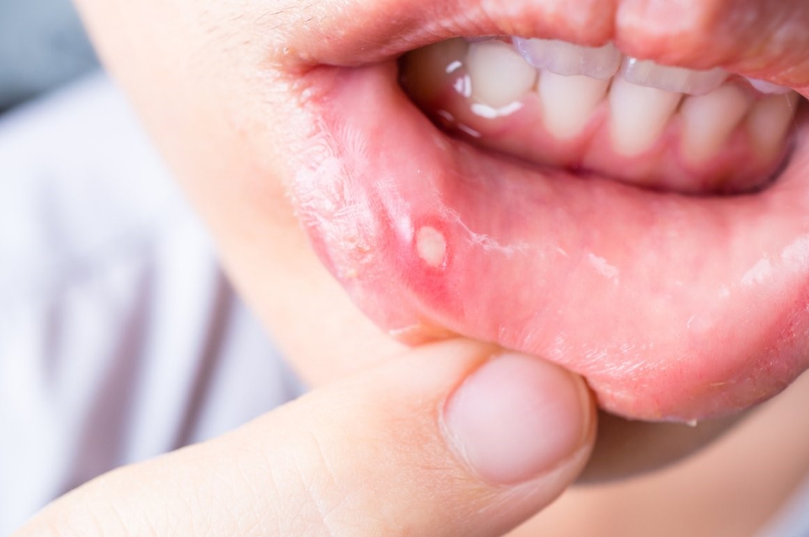 Let's talk about canker sores: once in a lifetime everyone has had annoying, small, ulcer-like sores in the mouth that cause burning and, in some cases, real pain